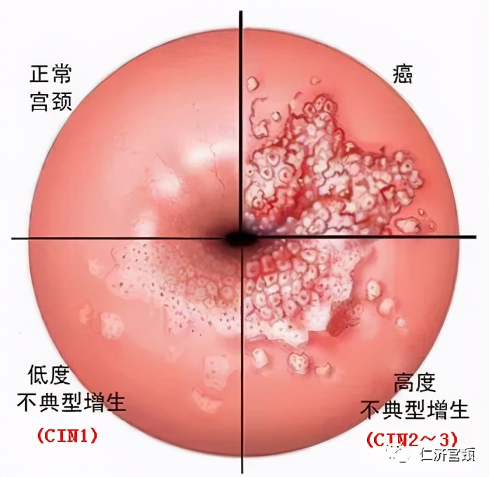 leep手术疼吗,leep手术后出血多久