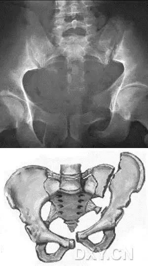 特殊骨折类型,特殊骨折体征
