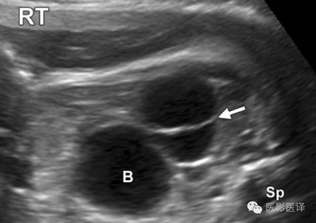 孕期发现卵巢囊肿有8cm左右,孕19周查出胎儿卵巢囊肿