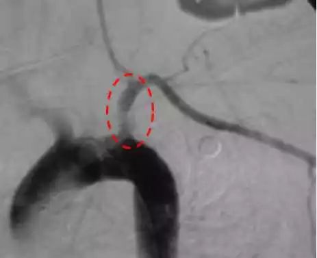 举例科普|介入能治疗哪些疾病?