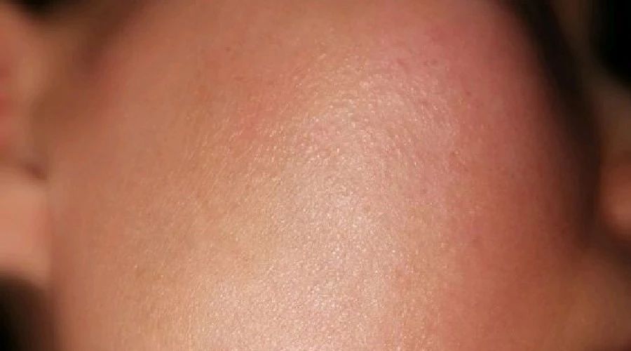 逆光疹是过敏性皮炎的一种吗,皮肤科医生专家谈荨麻疹