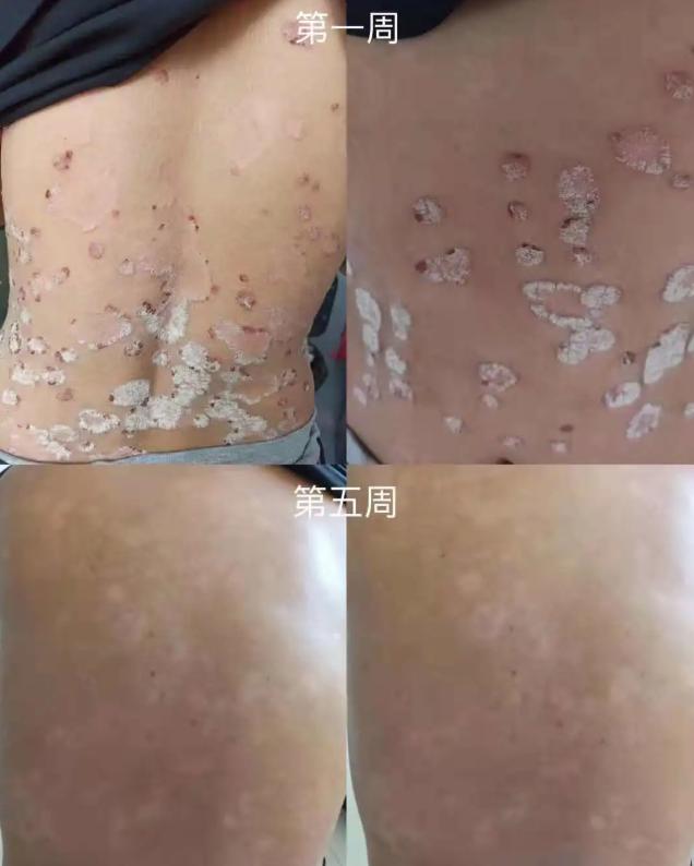 最新牛皮癣生物制剂,治牛皮癣的生物制剂有副作用吗