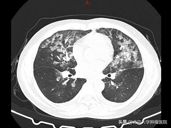 夫妻一方患了肺癌会传染吗,肺癌患者的口水会不会传染肺癌