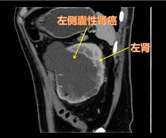 囊性肾癌与囊肿的区别,复杂肾囊肿和囊性肾癌
