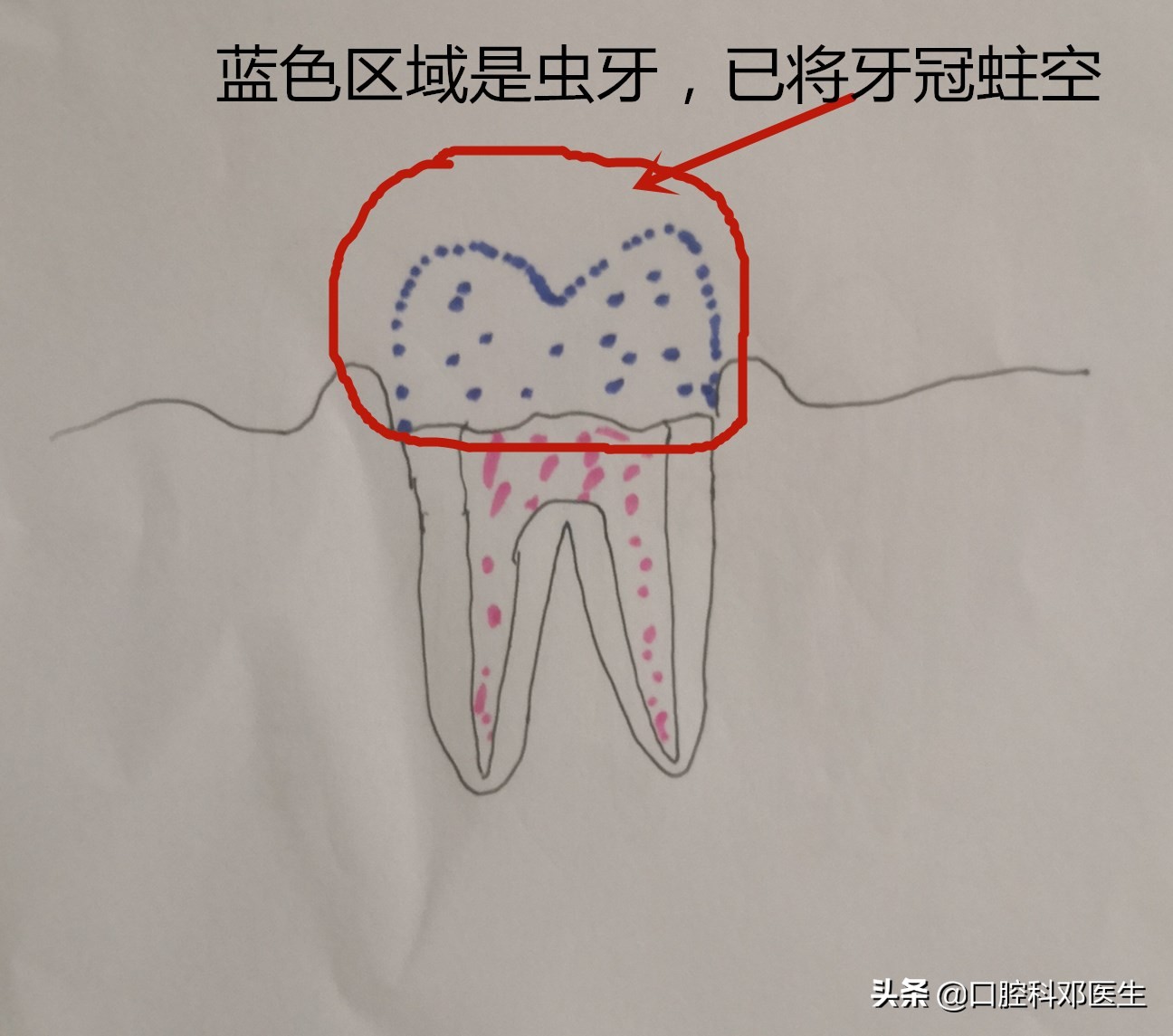 上排虫牙补牙全过程,虫牙补牙疼怎么办