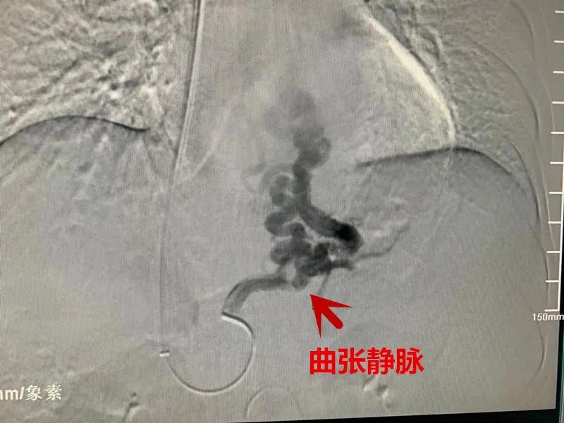肝硬化门脉高压物理治疗方法,肝硬化失代偿期门脉高压