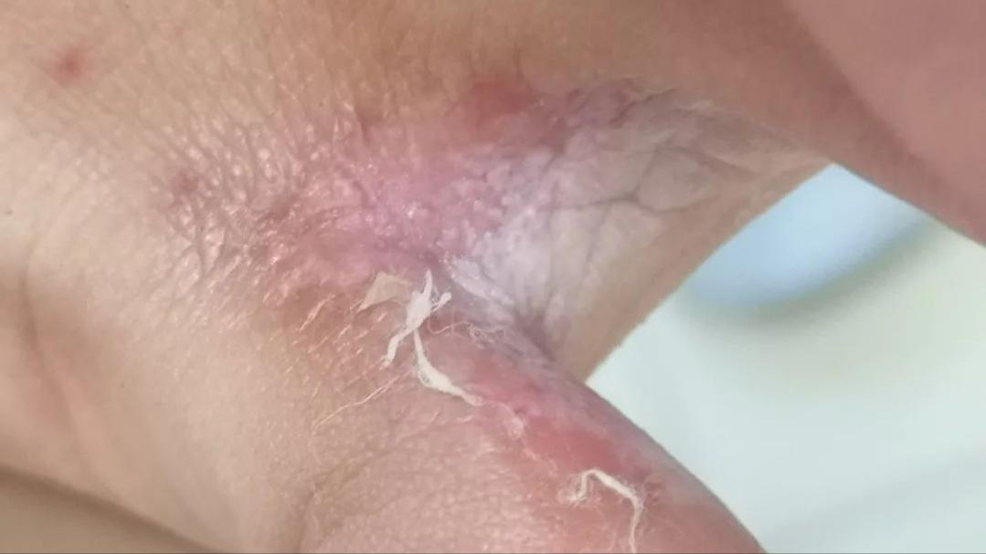 脚上干燥脱皮是真菌感染嘛,脚上因为真菌而开裂怎么办