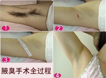 目前最好的腋臭手术方法,做腋臭去除手术挂什么科