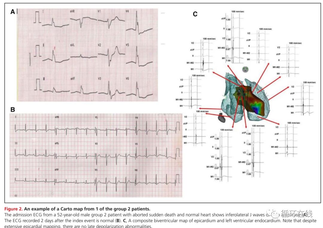 室性早搏射频消融治疗适应症,室性早搏的射频消融适应症