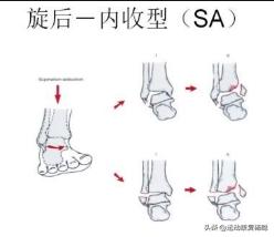 小腿胫骨弯曲怎么变直,五个月宝宝小腿胫骨弯曲