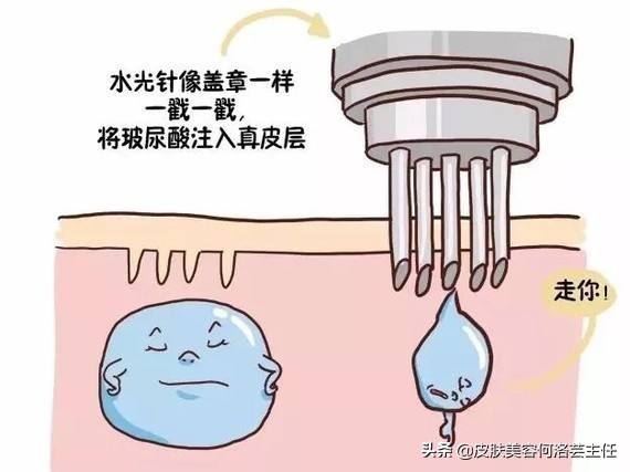 水光针的十问十答,长效水光针和短效水光针怎么样