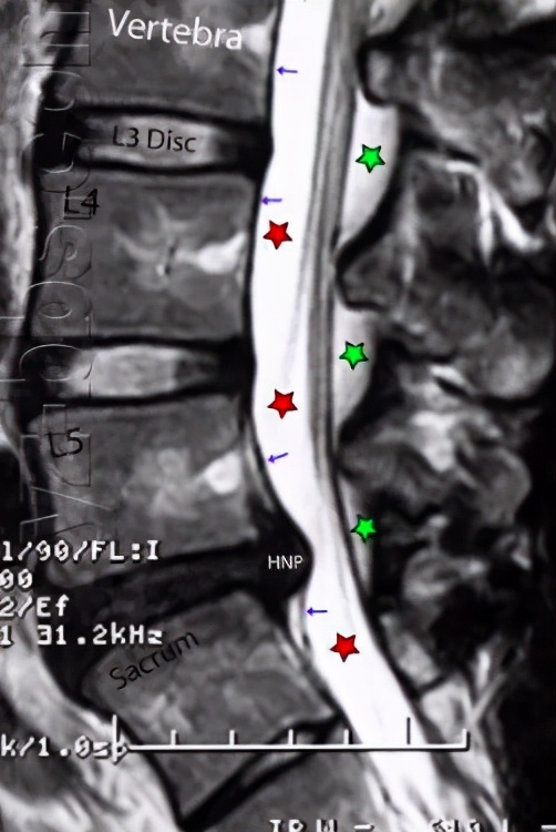 腰疼如何区分腰椎还是肾脏,腰疼怎么分辨是肾病还是腰病