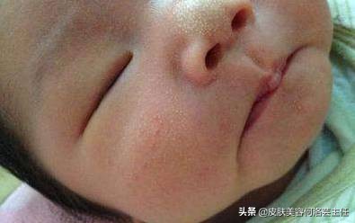 脂肪粒的形成原因及改善方法,脂肪粒形成的原因和消除方法