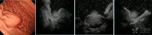 超声胃镜粘膜下隆起低回声占位,胃镜显示食道粘膜下隆起5mm