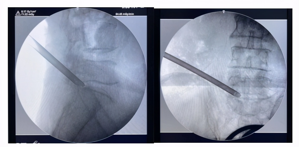 赶走疼痛,一身轻松!腰背痛,太原市中心医院疼痛科有妙招