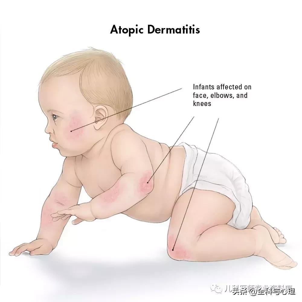 儿童痱子和湿疹，千万要分清楚了