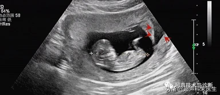 绒毛膜下血肿的超声图像,绒毛膜下血肿一般有啥症状