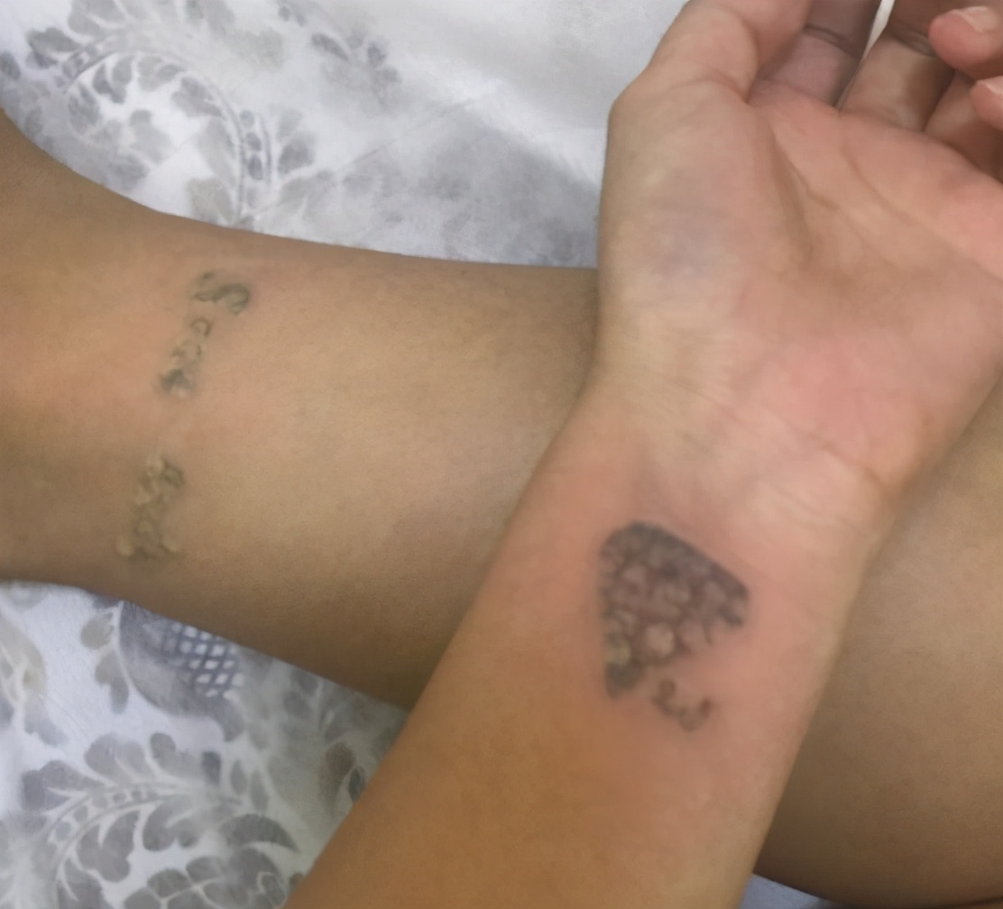 洗纹身不留疤会不会留印记,洗纹身最好的方法不留疤是真的吗