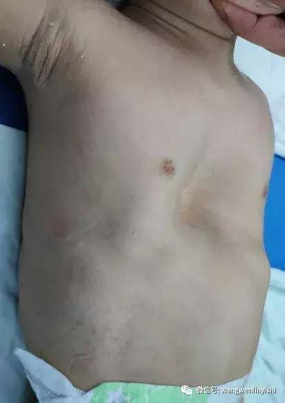 漏斗胸手术治疗全过程,负压吸盘漏斗胸最佳治愈年龄