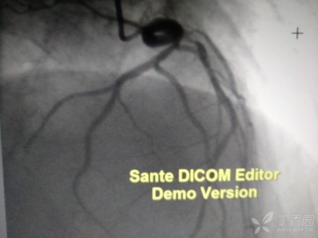 心电图心肌缺血冠脉造影正常,心脏彩超心电图冠脉造影正常