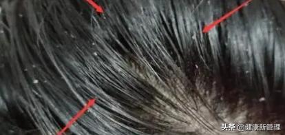 迎战奥运，也别忘了预防病理性头屑、头油及头皮瘙痒