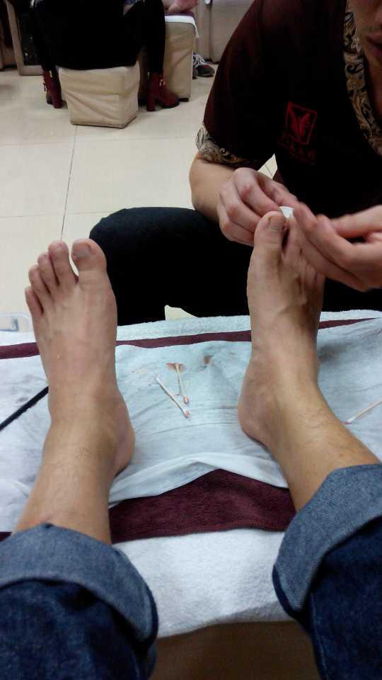 摆脱甲沟炎的痛苦之后的感想,甲沟炎的亲身经历