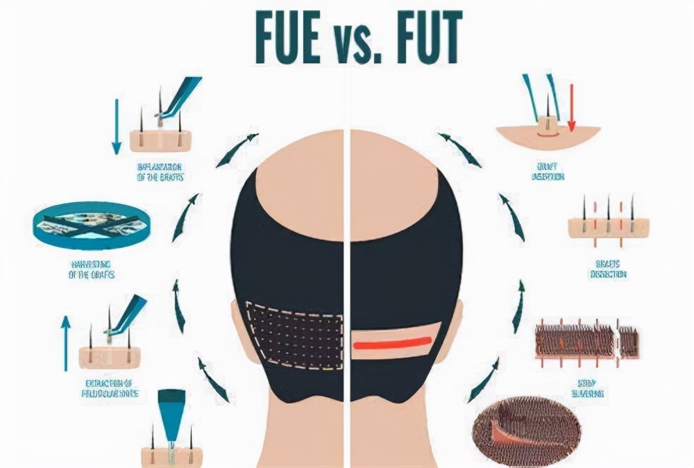 每天掉头发的次数判断脱发程度,怎么预防脱发掉头发