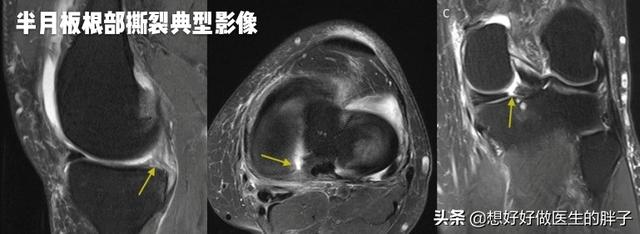 膝盖走路不怎么疼躺下就疼,儿童膝盖不动就不疼一走路就疼
