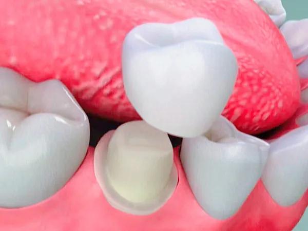 桩冠修复要做根管治疗吗,根管治疗加桩冠修复需要多长时间