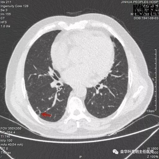 警惕-会是简单的肺大泡吗？