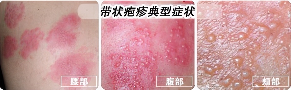 带状疱疹芜湖,芜湖广济医院门诊