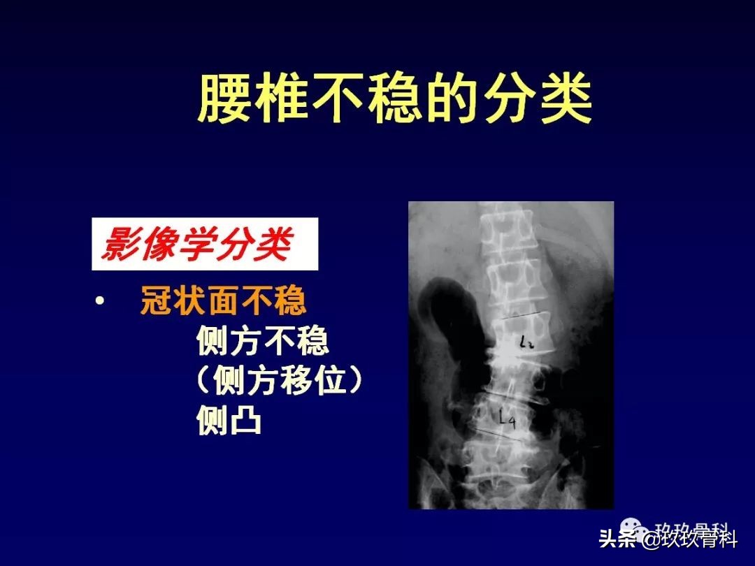 腰椎不稳最坏的结果,腰椎不稳的最佳治疗方法