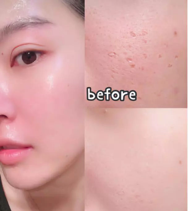 逃过了痘痘却没能逃过痘印痘坑,痘印痘坑的命中克星