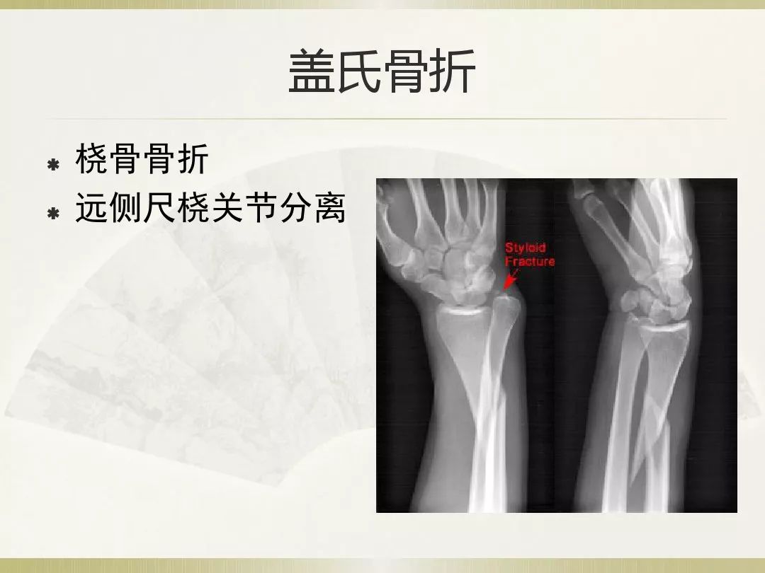 骨科x光片读片技巧,放射科骨科读片教程