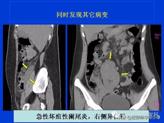 阑尾炎课件,阑尾炎的超声课件