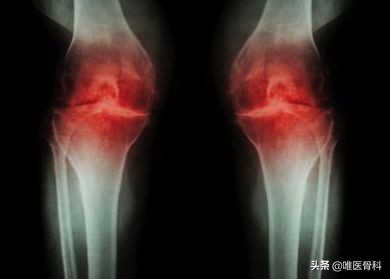 如何在家中防治骨关节炎？这5点你需要了解一下