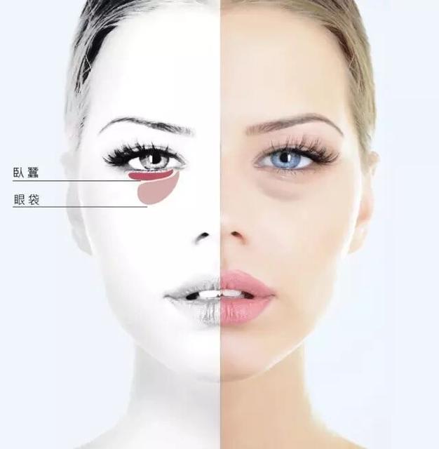 祛眼袋没有卧蚕了,没有卧蚕明星
