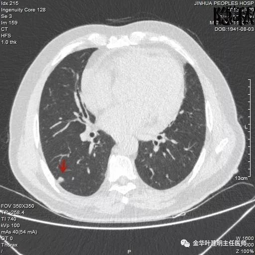 警惕-会是简单的肺大泡吗？