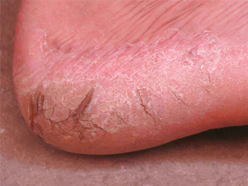 脚气发作难忍,脚气奇痒是什么原因