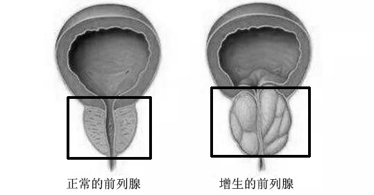 你有前列腺增生吗?需要早期治疗吗?这里给你答案