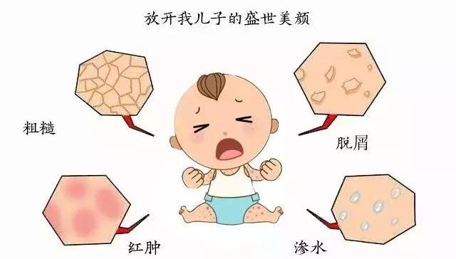 外阴湿疹用祛湿止痒软膏,专治儿童湿疹止痒特效药