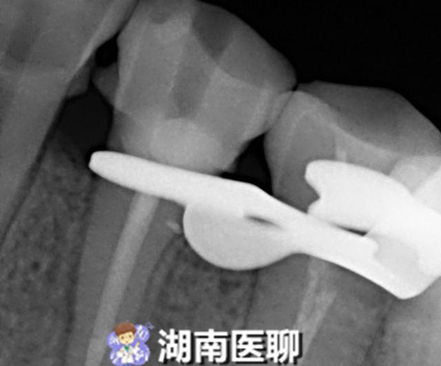 牙齿有洞很痛可以用牙痛药水吗,牙齿疼痛怎么办土方法治牙疼