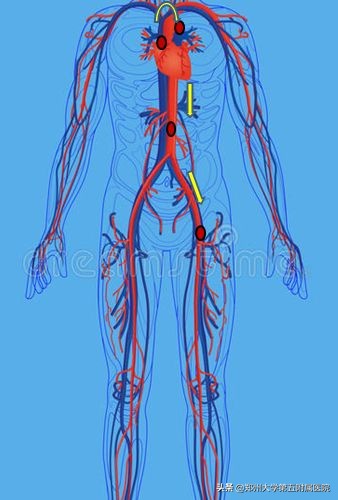 腿梗严重吗,为什么有的人脑梗心梗腿很正常