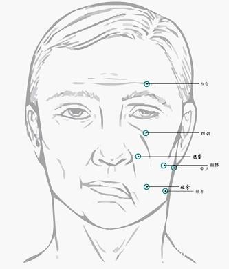 中风面瘫嘴歪眼斜怎么治疗,嘴歪眼斜是面瘫吗怎么治
