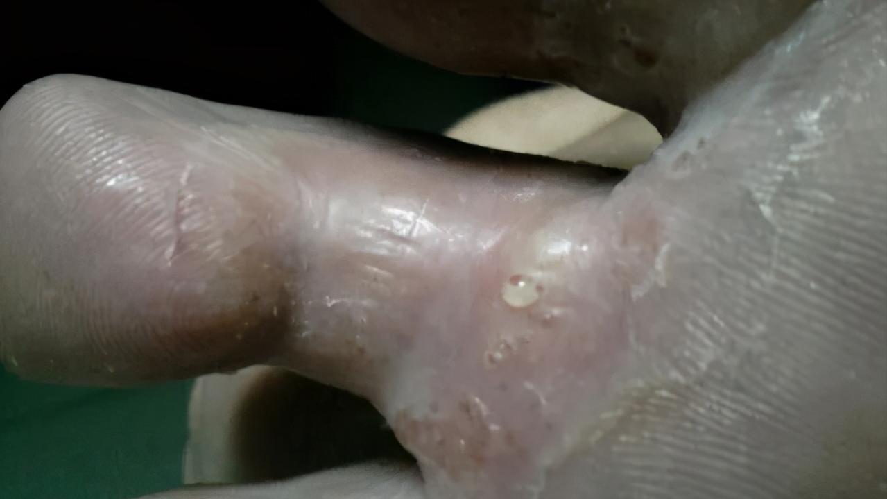 脚上真菌感染脱皮干裂怎么办,脚上脱皮又痒是真菌感染