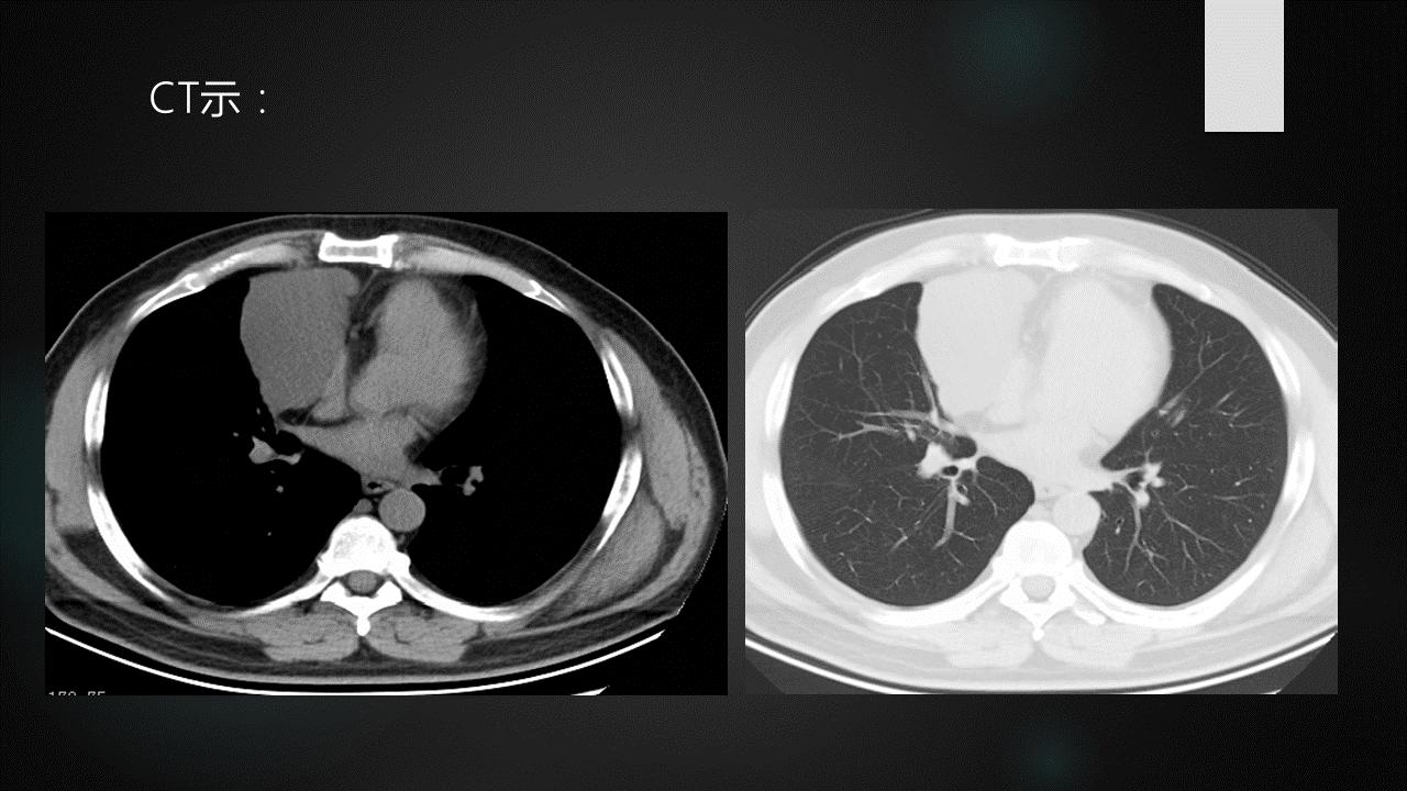 胸腺增生和纵隔肿瘤的区别和症状,纵隔胸腺肿瘤的常见临床症状表现