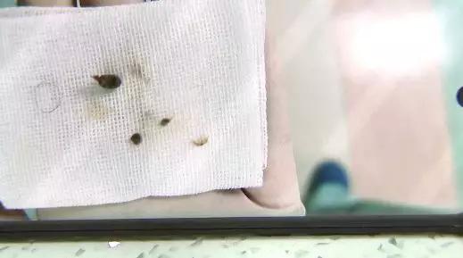 小孩鼻子塞进异物出血怎么处理,小孩耳朵塞进异物流血