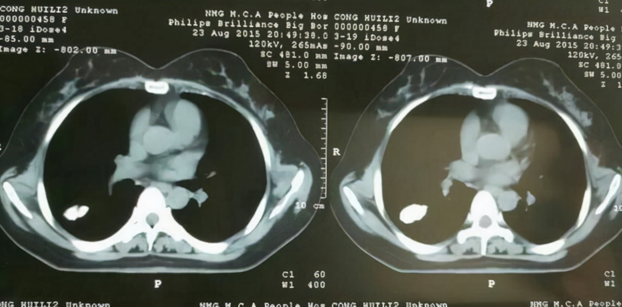 钙化是否说明病已好了,如何知道钙化呈现什么形状