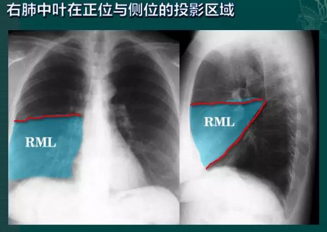 拿到胸部ct我们该怎么看,怎样看懂胸片报告单