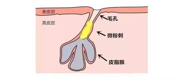 夏天出汗眼睛周围起疙瘩怎么回事,脸上眼睛周围有小米粒那样的疙瘩